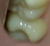 a close up of a tooth with a white filling