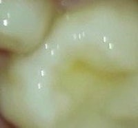 a close up of a tooth with a small amount of water