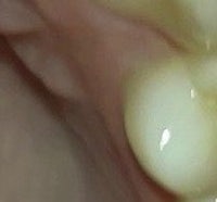 a close up of a person's mouth with a tooth in it